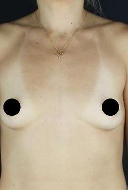 before-after-portrait-woman-retouched 1 before-after-portrait-woman-retouched 1