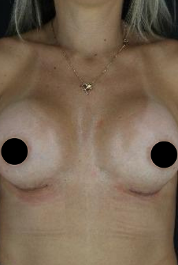 before-after-portrait-woman-retouched 2