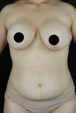 before-after-portrait-woman-retouched 6 before-after-portrait-woman-retouched 6